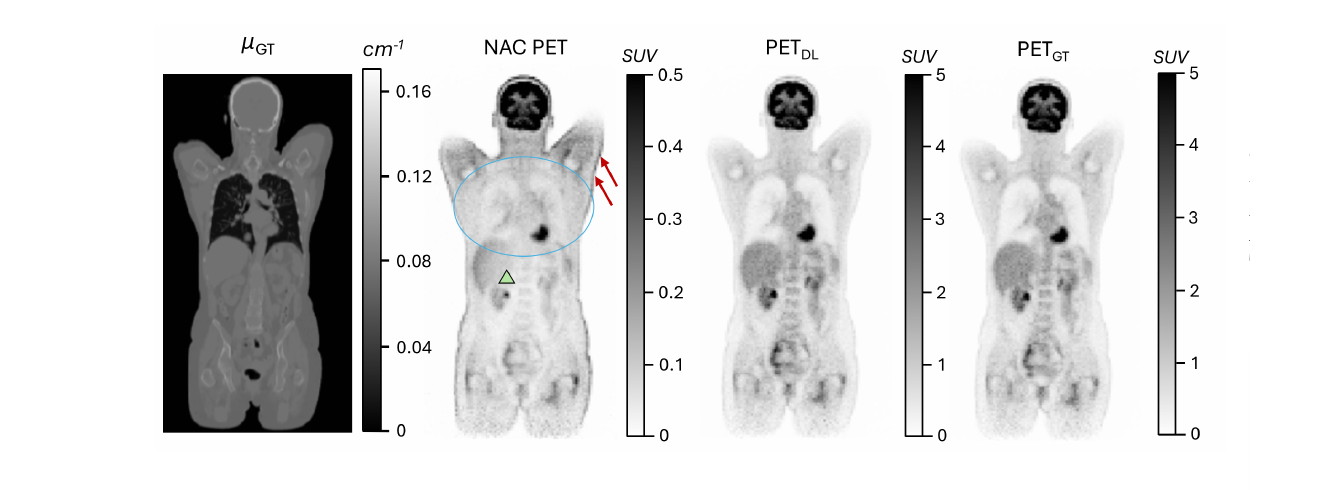 Comparison of PET scan reconstructions using predicted vs. ground-truth attenuation maps